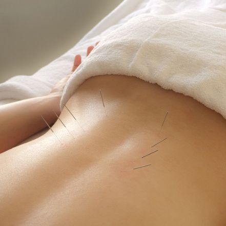 Kuivnõela tehnika (dry needling)